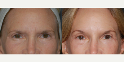 Case 9507 - Woman treated with Brow Lift