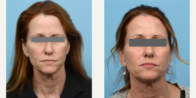 Case 9510 - 45-54 year old woman treated with Brow Lift