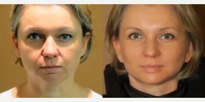 Case 9511 - Woman treated with Brow Lift