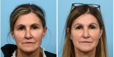 Case 9512 - 55-64 year old woman treated with Brow Lift