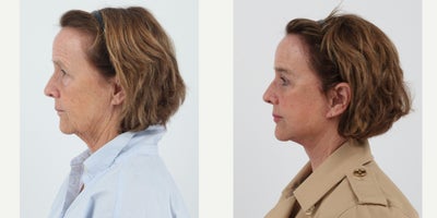 Case 9516 - 65-74 year old woman treated with Facelift, Neck Lift, Brow Lift, Eyelid Surgery, Facial Fat Transfer, CO2 Laser