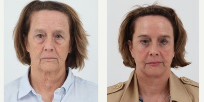 Case 9520 - 65-74 year old woman treated with Facelift, Neck Lift, Brow Lift, Eyelid Surgery, Facial Fat Transfer, CO2 Laser