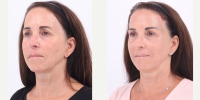 Case 9522 - 55-64 year old woman treated with Brow Lift, Eyelid Surgery