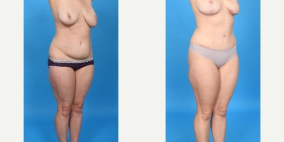 Case 953 - 35-44 year old woman treated with Abdominal Etching, Diastasis Recti Repair, Drainless Tummy Tuck, Liposculpture, Liposuction, M