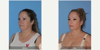 Case 9533 - 45-54 year old woman treated with Deep Plane Facelift, Neck Lift, Brow Lift, CO2 Laser, MACS Facelift