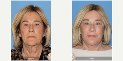 Case 9536 - 68 year old woman treated with Deep Plane Facelift, Neck Lift, Brow Lift, CO2 Laser, MACS Facelift