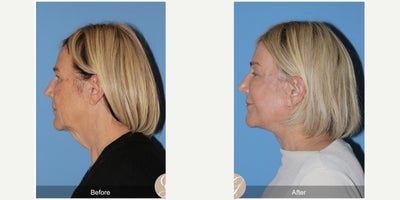 Case 9538 - 68 year old woman treated with Deep Plane Facelift, Neck Lift, Brow Lift, CO2 Laser, MACS Facelift