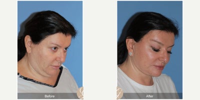 Case 9540 - 58 year old woman treated with Deep Plane Facelift, Neck Lift, Facelift, Brow Lift, MACS Facelift
