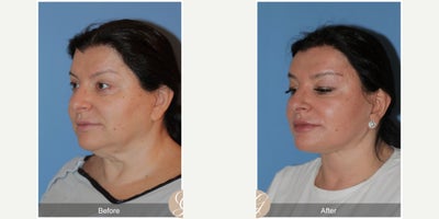Case 9541 - 58 year old woman treated with Deep Plane Facelift, Neck Lift, Facelift, Brow Lift, MACS Facelift