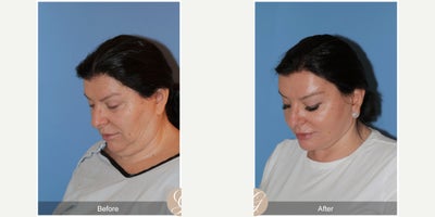 Case 9542 - 58 year old woman treated with Deep Plane Facelift, Neck Lift, Facelift, Brow Lift, MACS Facelift