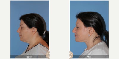 Case 9543 - 58 year old woman treated with Deep Plane Facelift, Neck Lift, Facelift, Brow Lift, MACS Facelift