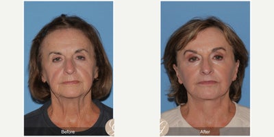 Case 9544 - 74 year old woman treated with Deep Plane Facelift, Neck Lift, Brow Lift, Lip Lift, MACS Facelift, Facelift