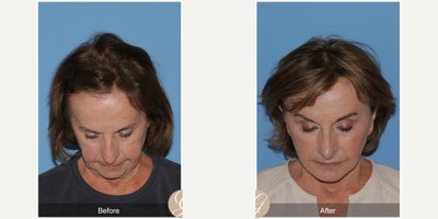 Case 9545 - 74 year old woman treated with Deep Plane Facelift, Neck Lift, Brow Lift, Lip Lift, MACS Facelift, Facelift