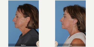 Case 9546 - 74 year old woman treated with Deep Plane Facelift, Neck Lift, Brow Lift, Lip Lift, MACS Facelift, Facelift