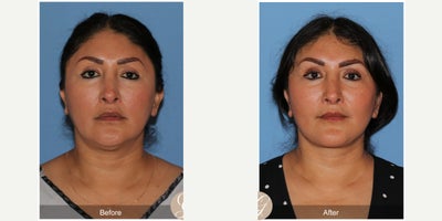 Case 9547 - 47 year old woman treated with Deep Plane Facelift, Neck Lift, Brow Lift, Buccal Fat Removal, MACS Facelift