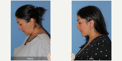 Case 9549 - 47 year old woman treated with Deep Plane Facelift, Neck Lift, Brow Lift, Buccal Fat Removal, MACS Facelift