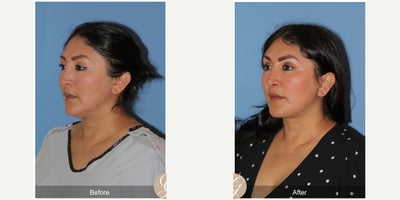 Case 9550 - 47 year old woman treated with Deep Plane Facelift, Neck Lift, Brow Lift, Buccal Fat Removal, MACS Facelift