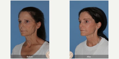 Case 9554 - 57 year old woman treated with Deep Plane Facelift, Facelift, Neck Lift, Brow Lift, Facial Fat Transfer, Lip Lift, CO2 Laser, Bo