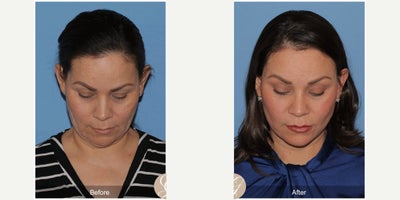 Case 9557 - 51 year old woman treated with Deep Plane Facelift, Facelift, Neck Lift, Brow Lift, Facial Fat Transfer, MACS Facelift