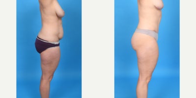 Case 956 - 35-44 year old woman treated with Abdominal Etching, Diastasis Recti Repair, Drainless Tummy Tuck, Liposculpture, Liposuction, M