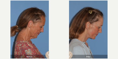 Case 9563 - 69 year old woman treated with Deep Plane Facelift, Facelift, Neck Lift, Brow Lift, CO2 Laser, Eyelid Surgery, Botox