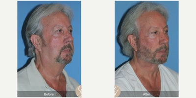 Case 9565 - 71 year old man treated with Deep Plane Facelift, Facelift, Neck Lift, Brow Lift, Facial Fat Transfer, MACS Facelift