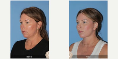 Case 9570 - 51 year old woman treated with Deep Plane Facelift, Facelift, Neck Lift, Brow Lift, Botox, MACS Facelift