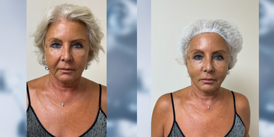 Case: 9571 - before and after photo of 65-74 year old woman treated with Nonsurgical Facelift, Thread Lift, Nonsurgical Neck Lift, Botox by Alexander Golberg, MD, DO