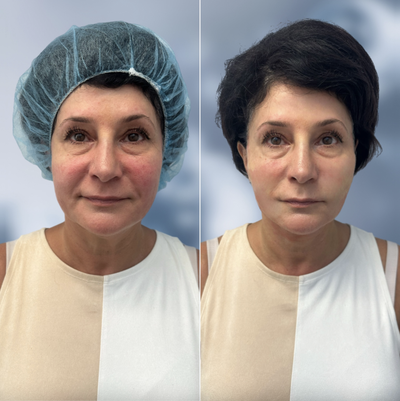 Case: 9572 - before and after photo of 55-64 year old woman treated with Thread Lift, Nonsurgical Facelift, Nonsurgical Neck Lift by Alexander Golberg, MD, DO