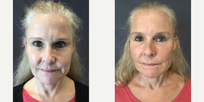 Case: 9573 - before and after photo of Woman treated with Thread Lift by Mark Berkowitz, MD