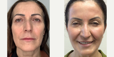 Case: 9574 - before and after photo of Woman treated with Thread Lift by Mark Berkowitz, MD