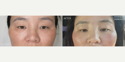 Case: 9575 - before and after photo of Woman treated with Thread Lift by Jason Emer, MD