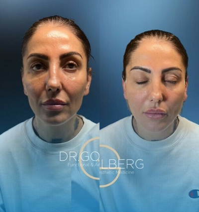 Case: 9576 - before and after photo of Woman treated with Thread Lift by Alexander Golberg, MD, DO