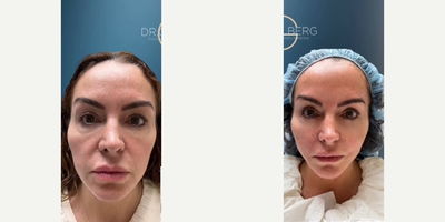 Case: 9577 - before and after photo of Woman treated with Thread Lift by Alexander Golberg, MD, DO