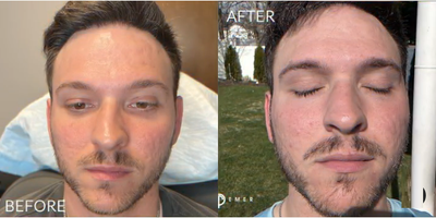 Case: 9578 - before and after photo of Man treated with Bellafill, CO2 Laser, PRP Injections, Thread Lift by Jason Emer, MD