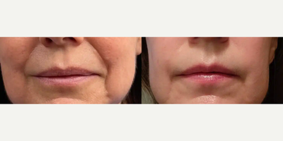 Case: 9579 - before and after photo of Woman treated with Thread Lift by Robert Poe, MD