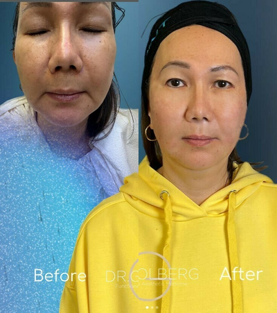 Case 9583 - Woman treated with Thread Lift