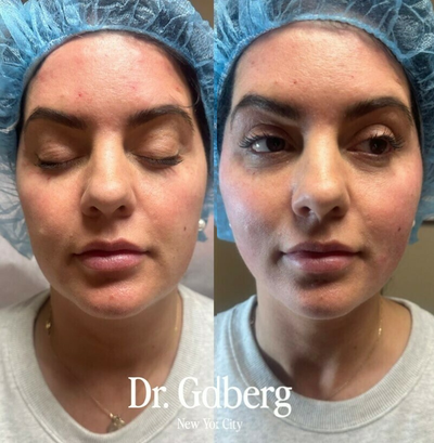 Case 9584 - Woman treated with Thread Lift