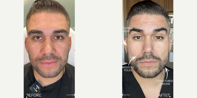 Case 9592 - Man treated with Thread Lift