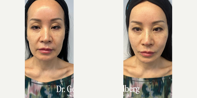 Case 9596 - Woman treated with Thread Lift