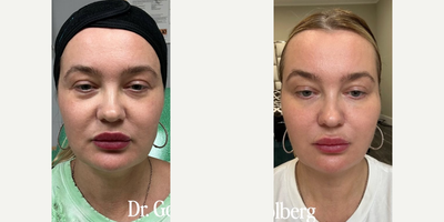 Case 9597 - Woman treated with Thread Lift