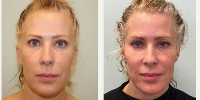 Case 9598 - 45-54 year old woman treated with Nonsurgical Facelift, Thread Lift