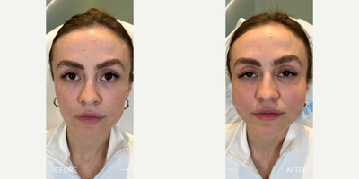 Case 9599 - 25-34 year old woman treated with Miracu, Thread Lift