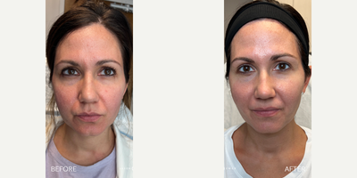 Case 9600 - 35-44 year old woman treated with Thread Lift