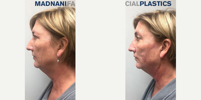 Case 9603 - Woman treated with Thread Lift