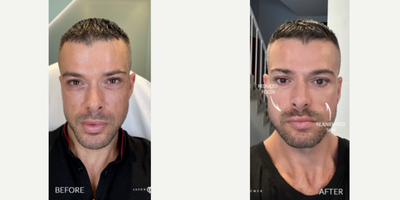 Case 9604 - 25-34 year old man treated with Thread Lift