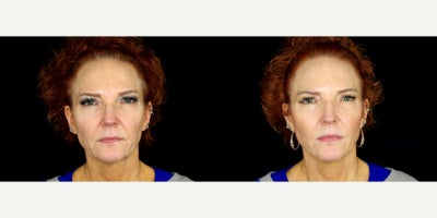 Case 9610 - 60 year old woman treated with Thread Lift