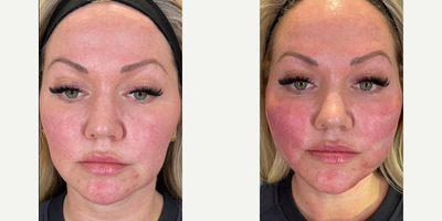 Case 9613 - Woman treated with Thread Lift