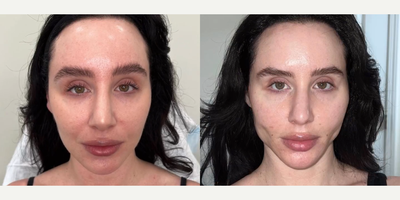 Case 9614 - Woman treated with Thread Lift