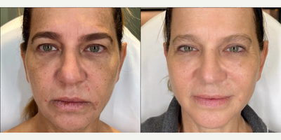 Case 9615 - Woman treated with Thread Lift